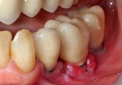 Journal LS - Implantologie dentaire Traitement laser assisté des ...